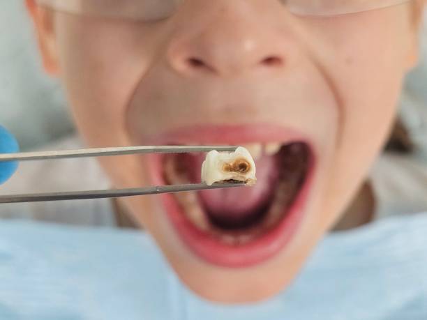 Best Emergency Tooth Extraction in East Bakersfield, CA
